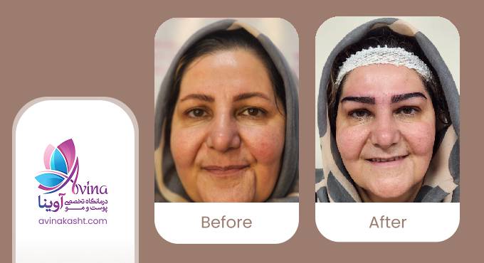 نمونه کار کاشت ابرو در کلینیک آوینا