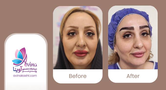 نمونه کار کاشت ابرو در کلینیک آوینا