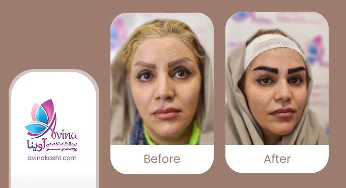 نمونه کار کاشت ابرو در کلینیک آوینا