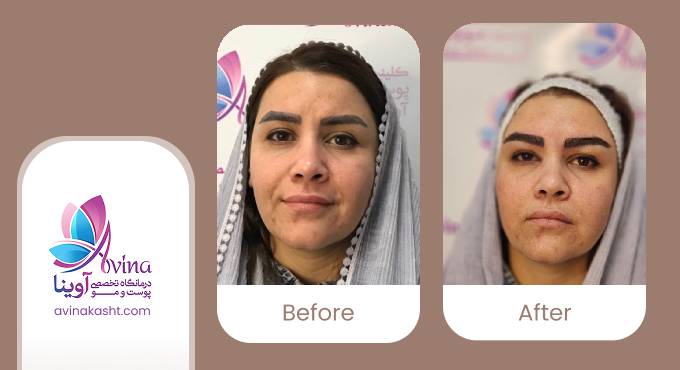 نمونه کار کاشت ابرو در کلینیک آوینا
