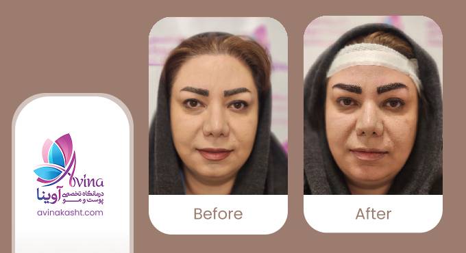 نمونه کار کاشت ابرو در کلینیک آوینا