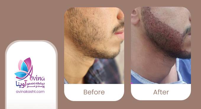 نمونه کار کاشت ریش در کلینیک آوینا
