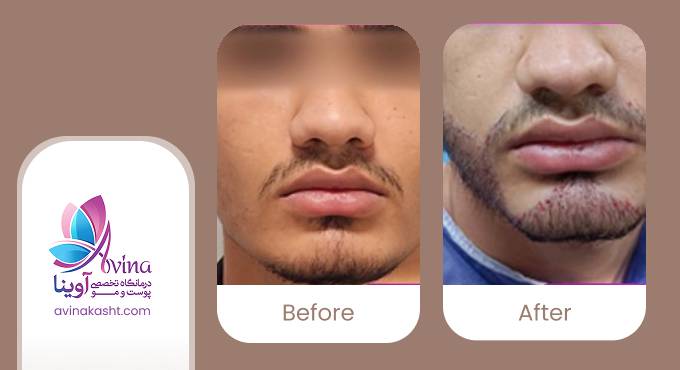 نمونه کار کاشت ریش در کلینیک آوینا