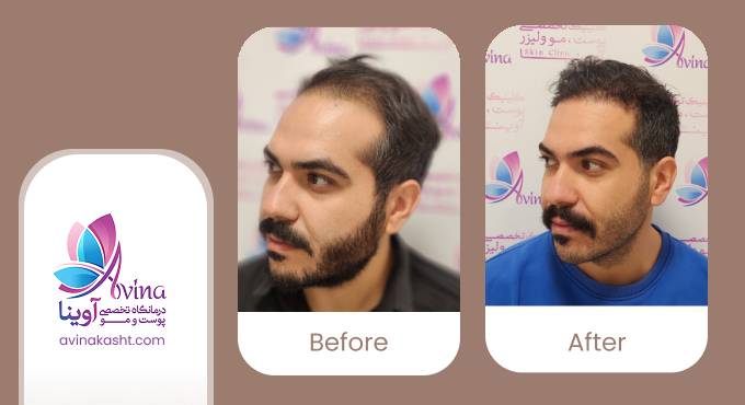 نمونه کار کاشت مو در کلینیک آوینا