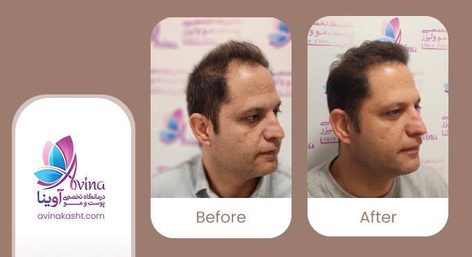 نمونه کار کاشت مو در کلینیک آوینا
