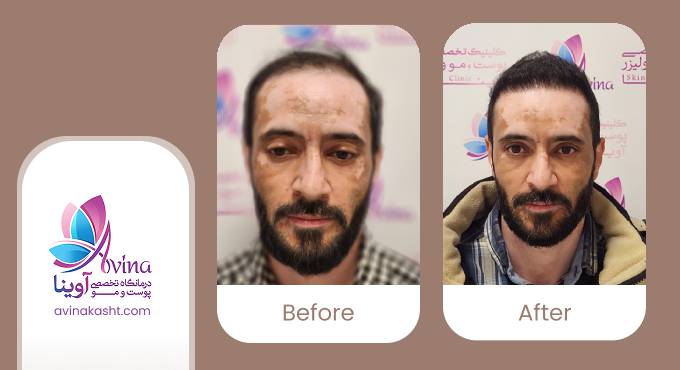 نمونه کار کاشت مو در کلینیک آوینا