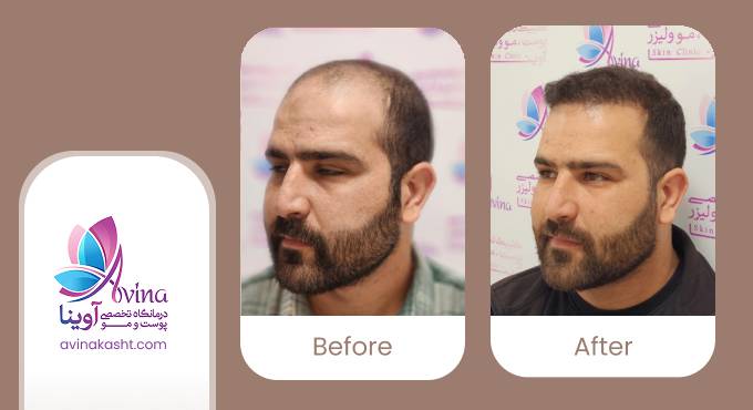 نمونه کار کاشت مو در کلینیک آوینا