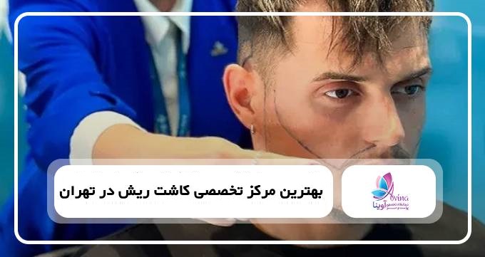 بهترین مرکز تخصصی کاشت ریش در تهران