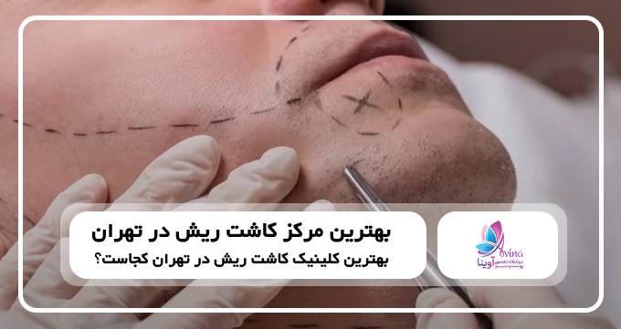 بهترین مرکز کاشت ریش در تهران