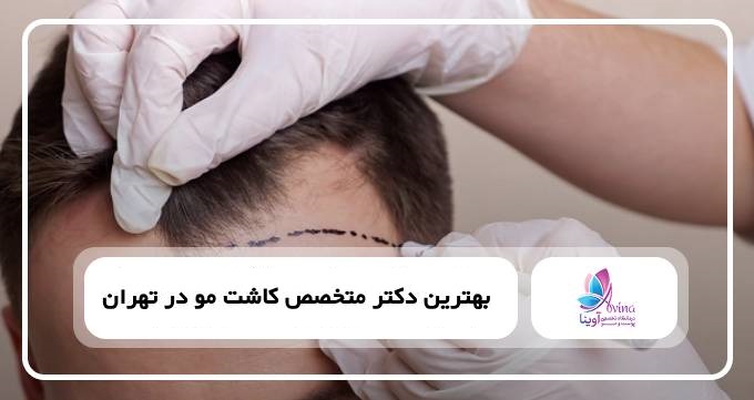 بهترین دکتر متخصص کاشت مو در تهران✅【سال1404】