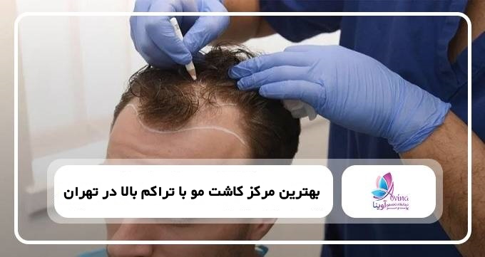 بهترین مرکز کاشت مو با تراکم بالا در تهران