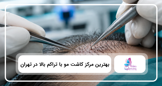 بهترین مرکز کاشت مو با تراکم بالا در تهران【سال1404】