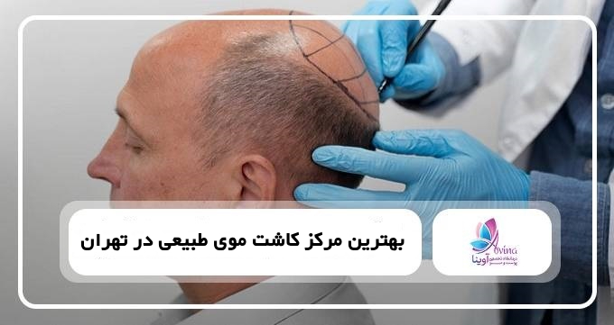 بهترین مرکز کاشت موی طبیعی در تهران