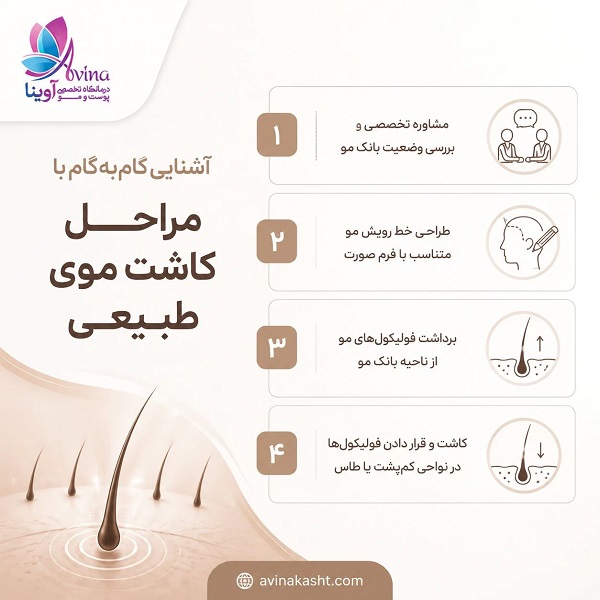 آشنایی گام به گام با مراحل کاشت موی طبیعی