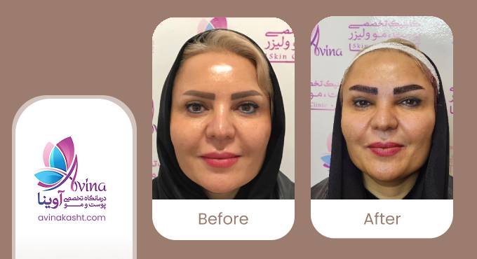 نمونه کار کاشت ابرو در کلینیک آوینا