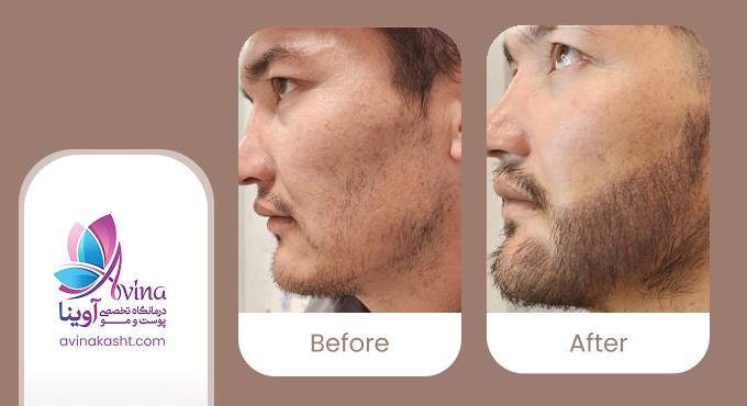 نمونه کار کاشت ریش در کلینیک آوینا