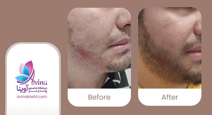 نمونه کار کاشت ریش در کلینیک آوینا