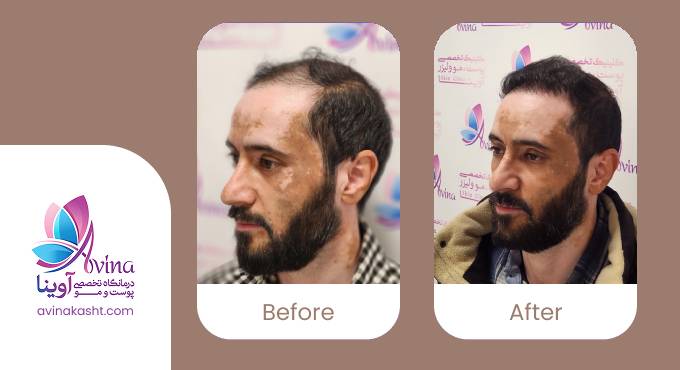 نمونه کار کاشت مو در کلینیک آوینا