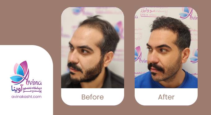 نمونه کار کاشت مو در کلینیک آوینا