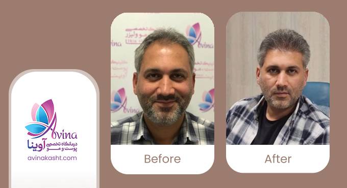 نمونه کار کاشت مو در کلینیک آوینا