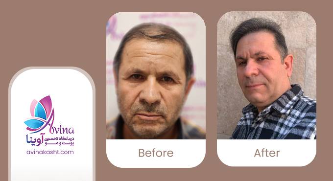 نمونه کار کاشت مو در کلینیک آوینا
