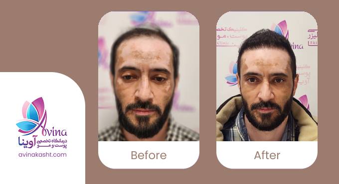 نمونه کار کاشت مو در کلینیک آوینا