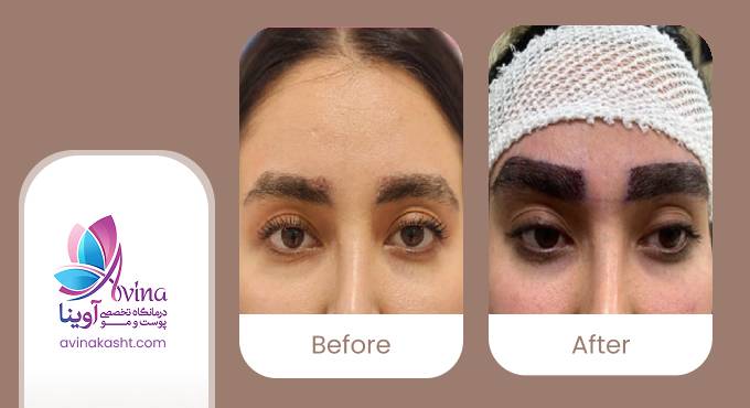 نمونه کار کاشت ابرو در کلینیک آوینا