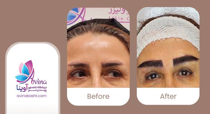نمونه کار کاشت ابرو در کلینیک آوینا