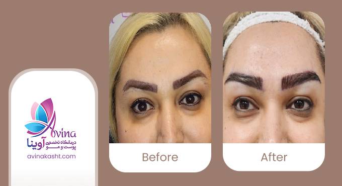 نمونه کار کاشت ابرو در کلینیک آوینا