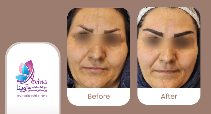 کاشت ابرو در کلینیک آوینا