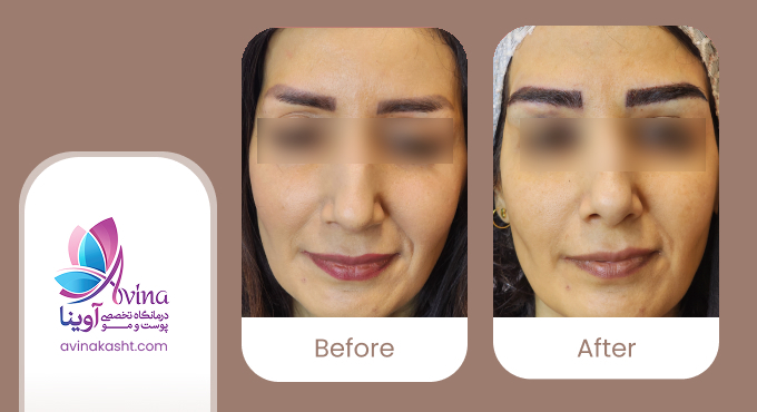 کاشت ابرو در کلینیک آوینا