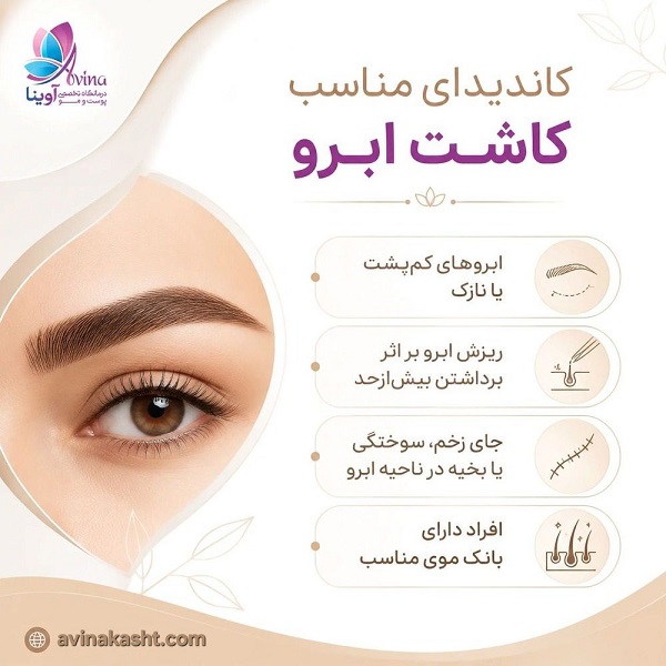 کاندیدای مناسب کاشت ابرو