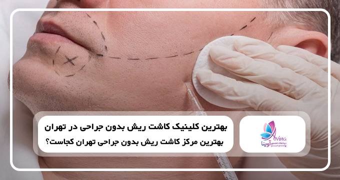 بهترین کلینیک کاشت ریش بدون جراحی در تهران
