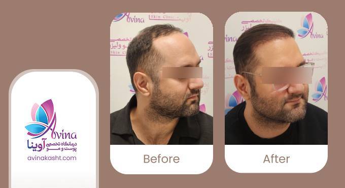نمونه کار کاشت مو در کلینیک آوینا