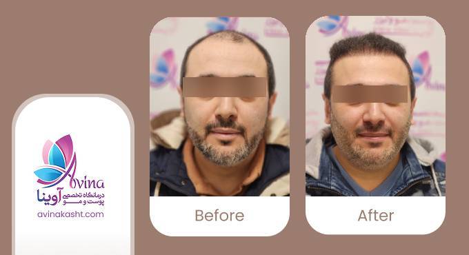 نمونه کار کاشت مو در کلینیک آوینا