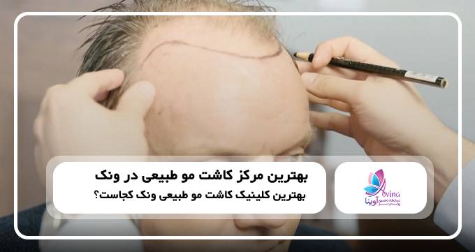 بهترین مرکز کاشت موی طبیعی در ونک