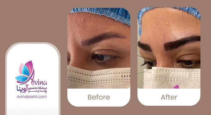 نمونه کار کاشت ابرو در کلینیک آوینا