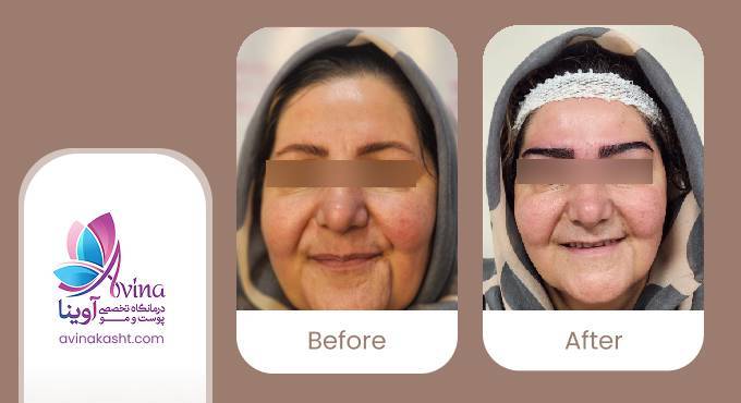 نمونه کار کاشت ابرو در کلینیک آوینا