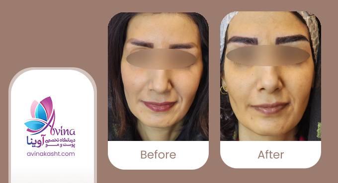 نمونه کار کاشت ابرو در کلینیک آوینا
