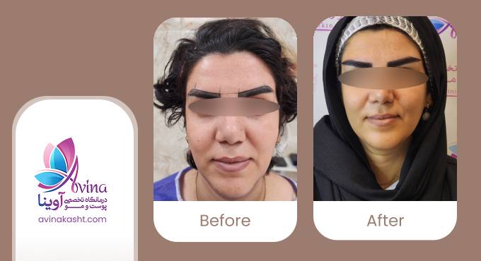 نمونه کار کاشت ابرو در کلینیک آوینا