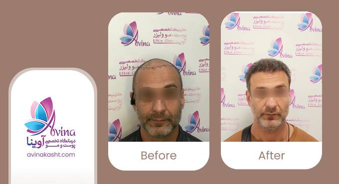 نمونه کار کاشت مو در کلینیک آوینا