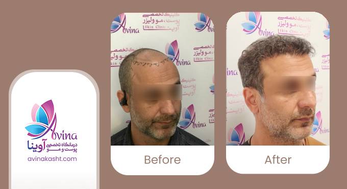 نمونه کار کاشت مو در کلینیک آوینا