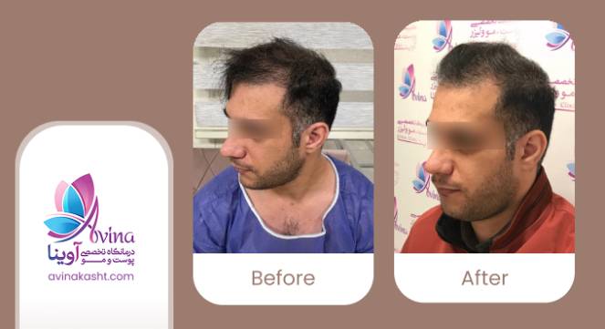 نمونه کار کاشت مو در کلینیک آوینا