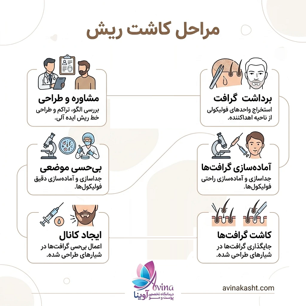 مراحل کاشت ریش