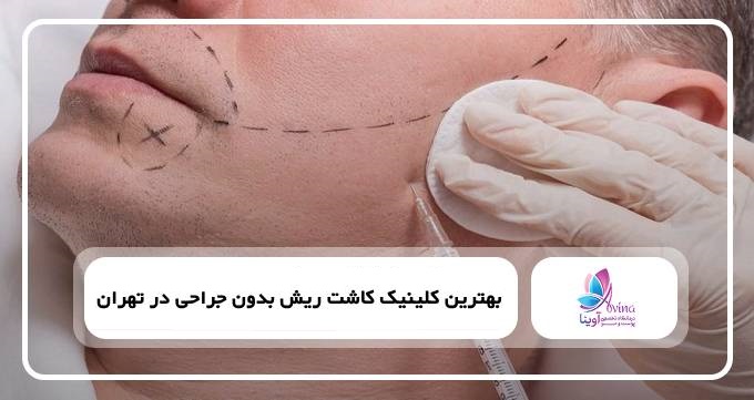 بهترین کلینیک کاشت ریش بدون جراحی در تهران