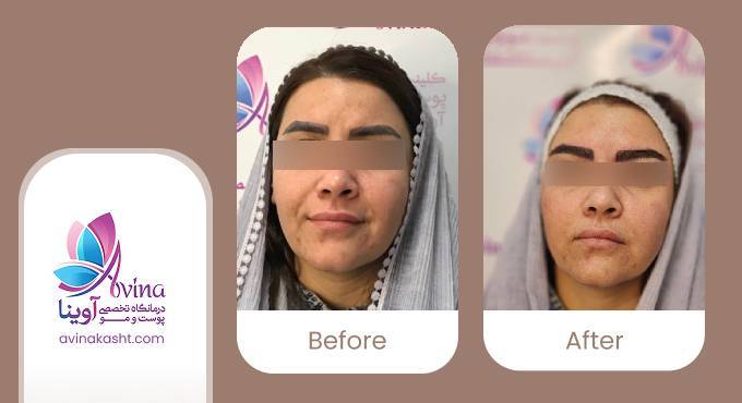نمونه کار کاشت ابرو در کلینیک آوینا