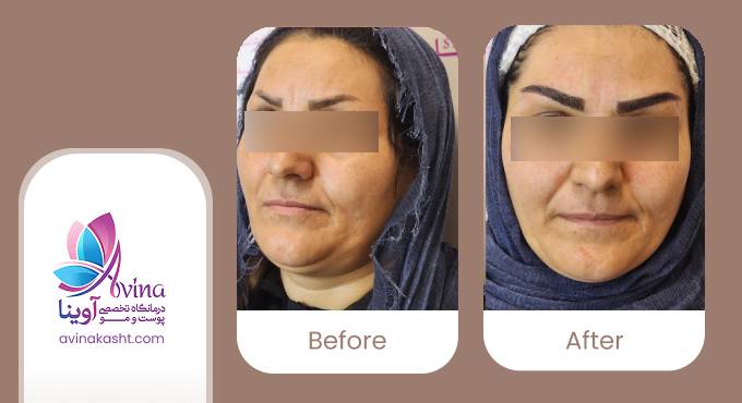 نمونه کار کاشت ابرو در کلینیک آوینا