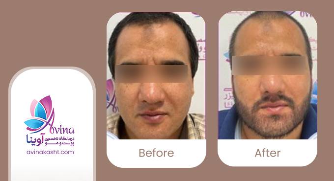 نمونه کار کاشت ریش در کلینیک آوینا
