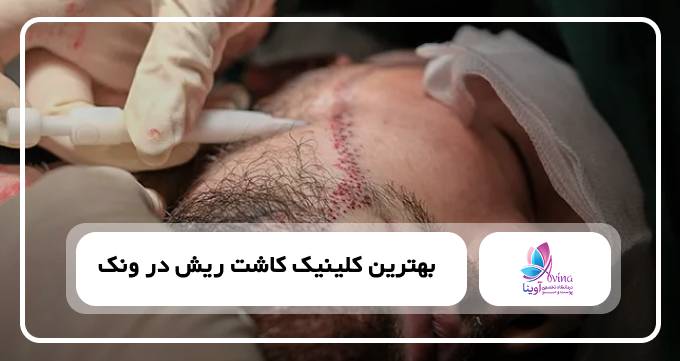 بهترین کلینیک کاشت ریش در ونک