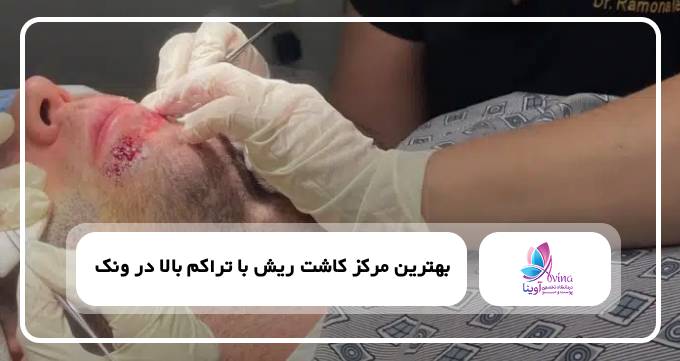 بهترین مرکز کاشت ریش با تراکم بالا در ونک✅【سال۱۴۰۴】⚡